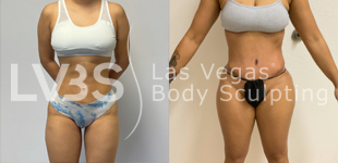 before and after picture