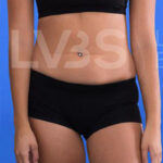 Liposuction Before & After Patient #344