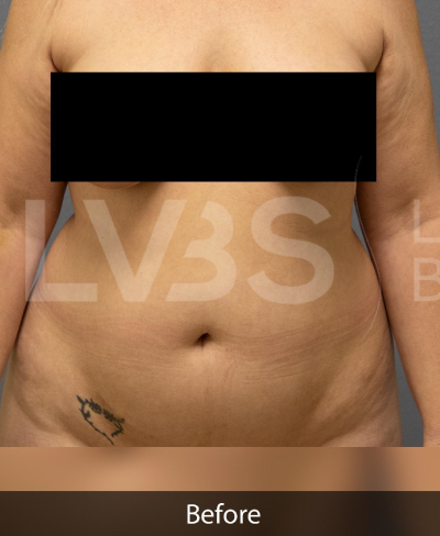Liposuction Before & After Patient #373
