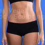 Liposuction Before & After Patient #344