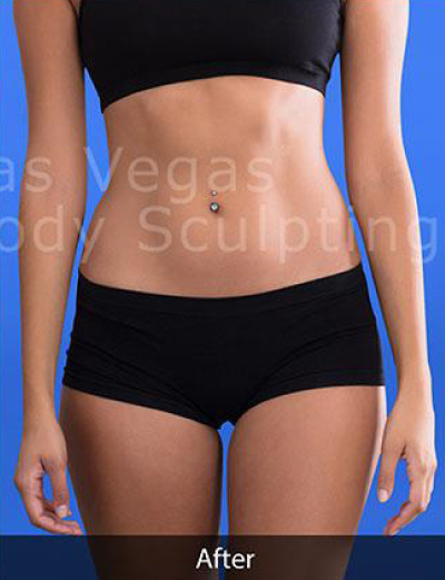 Liposuction Before & After Patient #344