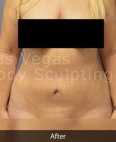 Liposuction Before & After Patient #373