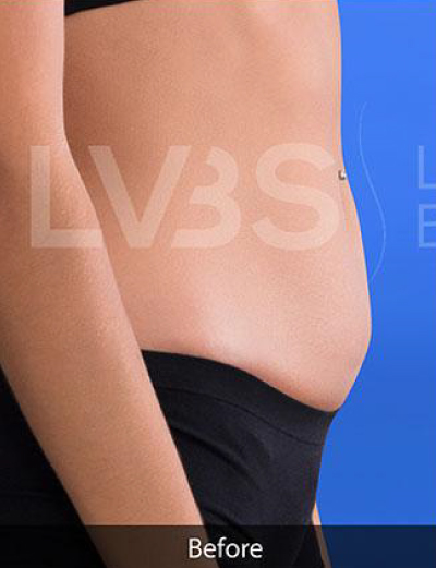 Liposuction Before & After Patient #344
