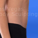 Liposuction Before & After Patient #344