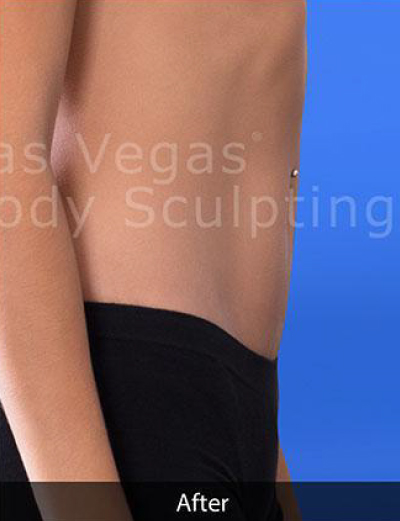 Liposuction Before & After Patient #344