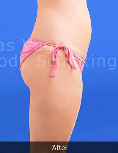 Liposuction Before & After Patient #349
