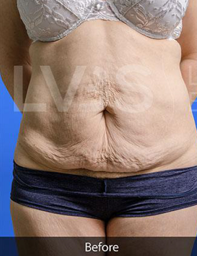 Liposuction Before & After Patient #360
