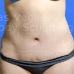 Liposuction Before & After Patient #360