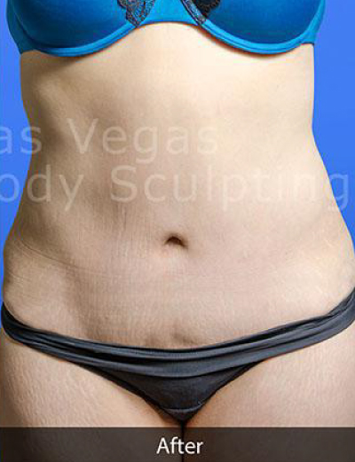 Liposuction Before & After Patient #360