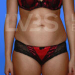 Liposuction Before & After Patient #363