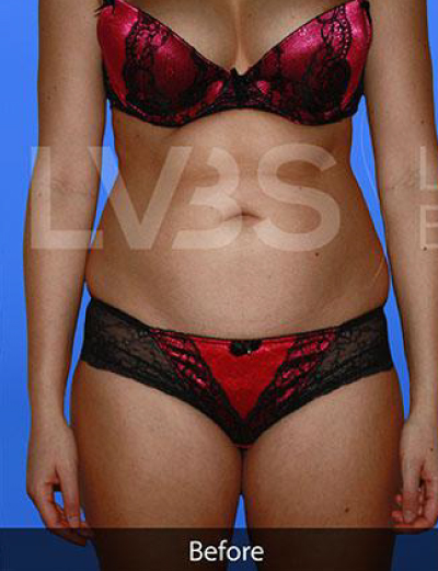 Liposuction Before & After Patient #363