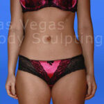 Liposuction Before & After Patient #363