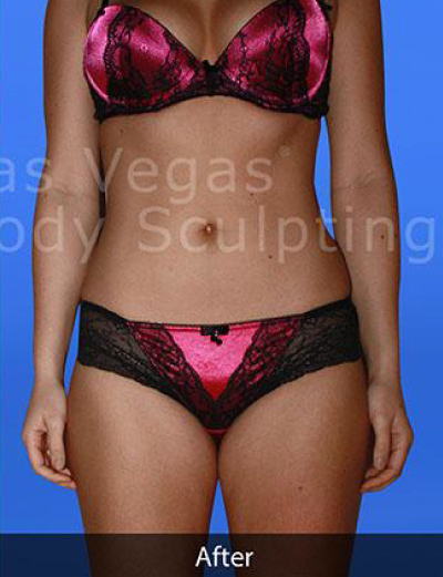Liposuction Before & After Patient #363