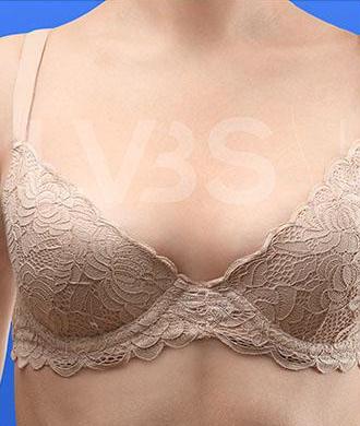Breast Augmentation Before & After Patient #202