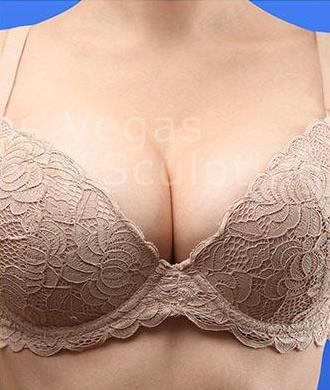 Breast Augmentation Before & After Patient #202