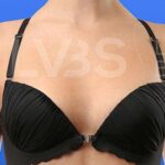 Breast Augmentation Before & After Patient #205