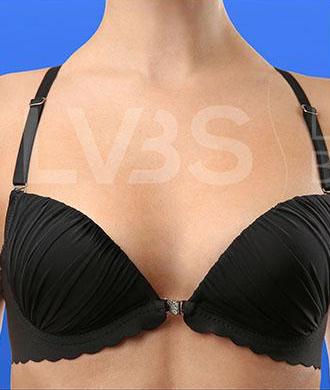Breast Augmentation Before & After Patient #205