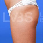 Brazilian Butt Lift (Fat Transfer to Butt) Before & After Patient #173