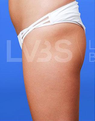 Brazilian Butt Lift (Fat Transfer to Butt) Before & After Patient #173