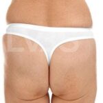Brazilian Butt Lift (Fat Transfer to Butt) Before & After Patient #176