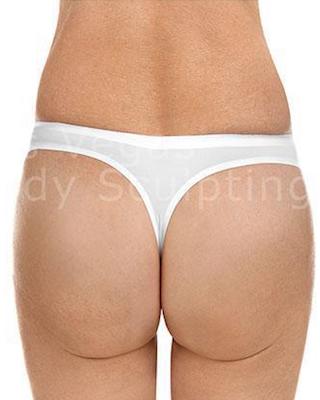 Brazilian Butt Lift (Fat Transfer to Butt) Before & After Patient #176