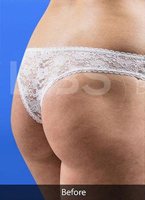Brazilian Butt Lift (Fat Transfer to Butt) Before & After Patient #196