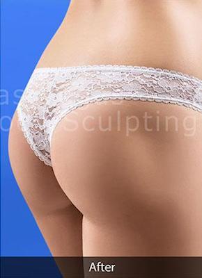 Brazilian Butt Lift (Fat Transfer to Butt) Before & After Patient #196