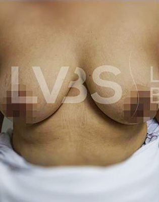 Breast Augmentation Before & After Patient #208