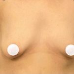 Breast Augmentation Before & After Patient #433