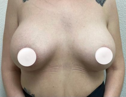 Breast Augmentation Before & After Patient #433