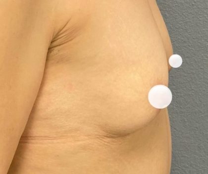 Breast Augmentation Before & After Patient #433