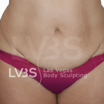 Tummy Tuck Before & After Patient #507
