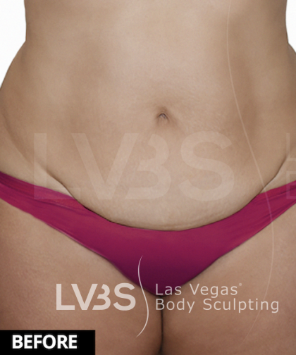 Tummy Tuck Before & After Patient #507