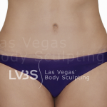 Tummy Tuck Before & After Patient #507