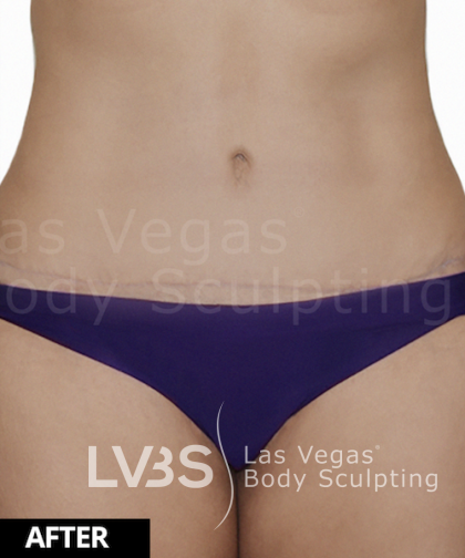 Tummy Tuck Before & After Patient #507