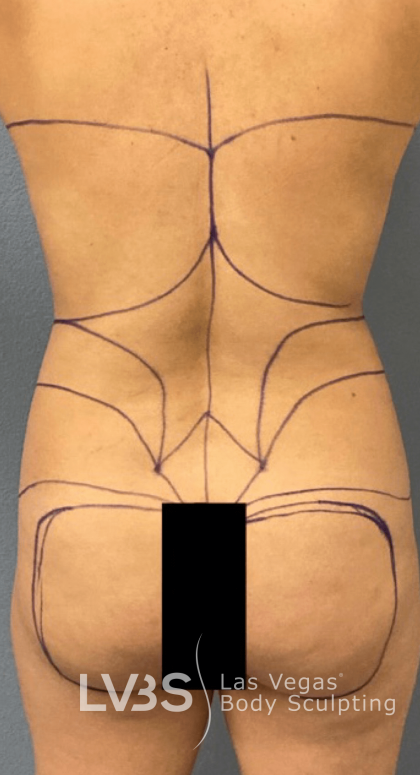 Brazilian Butt Lift (Fat Transfer to Butt) Before & After Patient #516