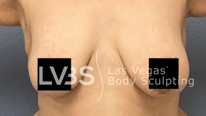 Breast Before & After Patient #513