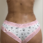 Brazilian Butt Lift (Fat Transfer to Butt) Before & After Patient #516