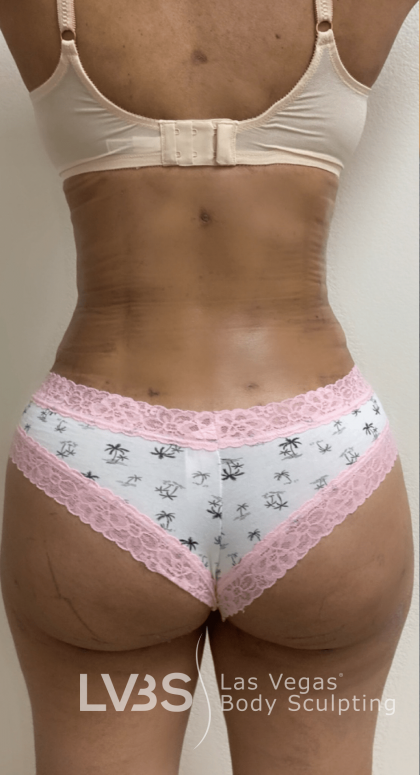 Brazilian Butt Lift (Fat Transfer to Butt) Before & After Patient #516