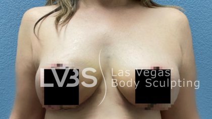 Breast Before & After Patient #513