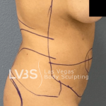 Brazilian Butt Lift (Fat Transfer to Butt) Before & After Patient #516