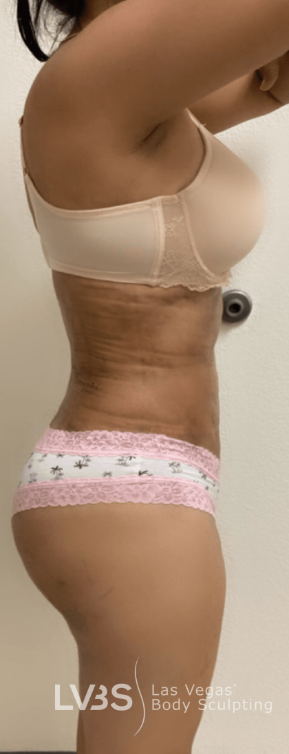 Brazilian Butt Lift (Fat Transfer to Butt) Before & After Patient #516