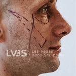 Blepharoplasty Before & After Patient #598