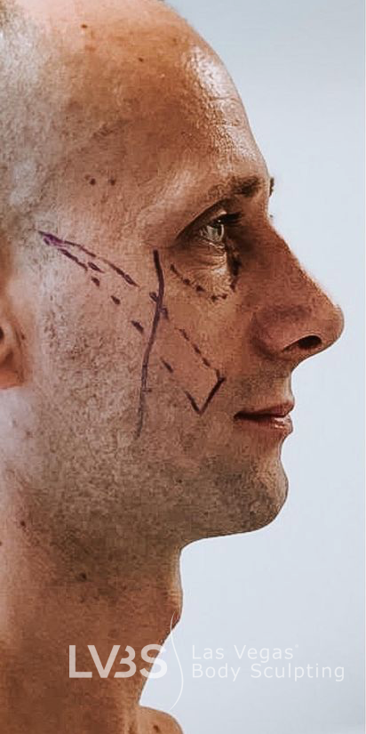 Blepharoplasty Before & After Patient #598