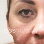Facelift Before & After Patient #601