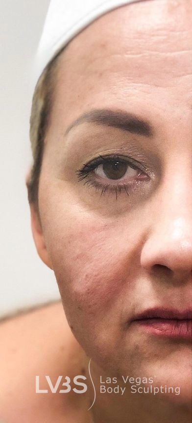 Facelift Before & After Patient #601