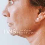 Facelift Before & After Patient #605