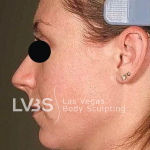Neck Lift Before & After Patient #610