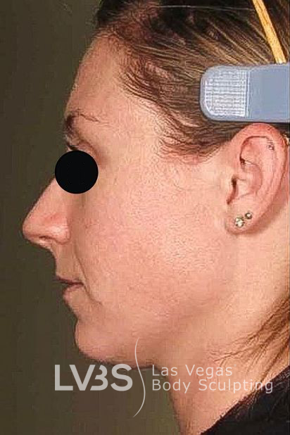 Neck Lift Before & After Patient #610