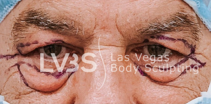 Blepharoplasty Before & After Patient #595